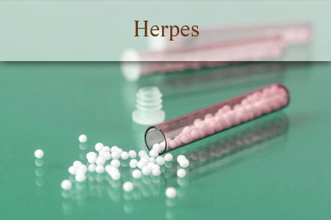 Welche Globuli helfen bei Herpes?