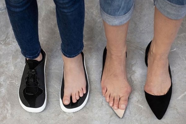 Hallux valgus, Knieprobleme und Fehlstellungen: Folgen falscher Schuhe ignoriert