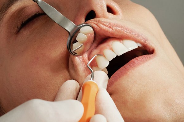 Professionelle Zahnreinigung: Sinnvoll für die Zahnhygiene?